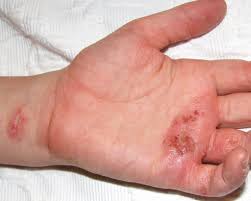 image of a person with a skin rash